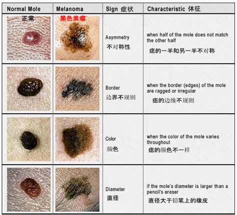 胸部長黑痣|哪種痣是致死率超高的「索命痣」？5 大關鍵辨別癌病。